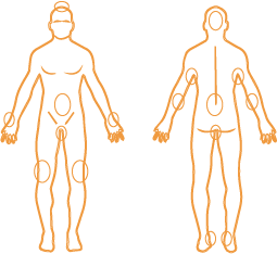 psoriasis