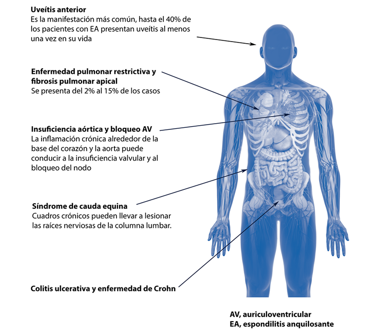 Espondilitis anquilosante