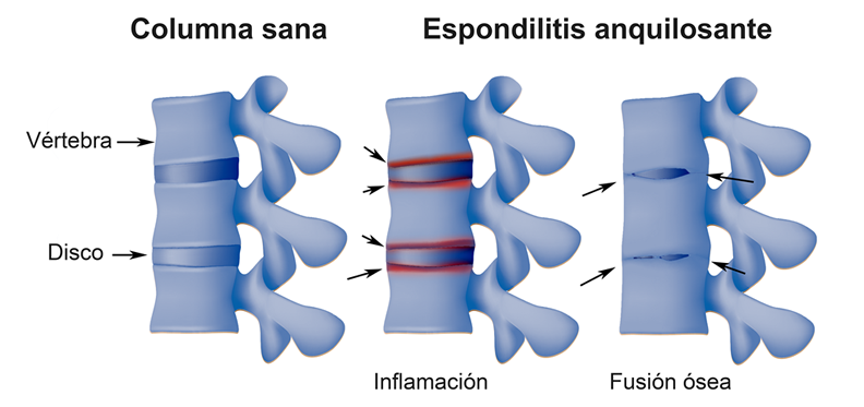 Espondilitis anquilosante - Manifestaciones