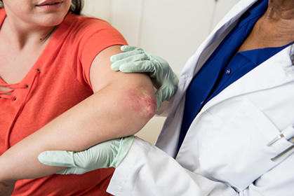 Psoriasis example