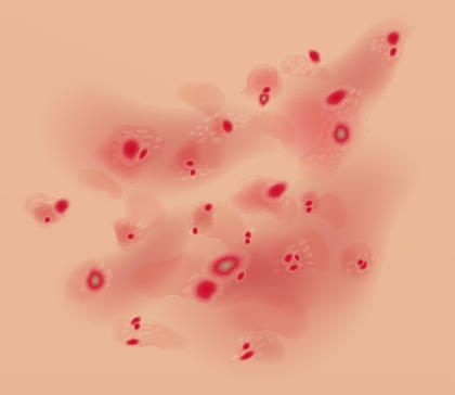Psoriasis en gotas