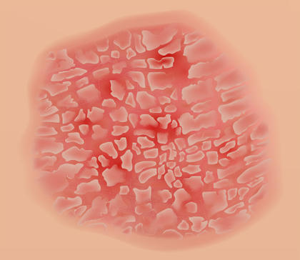 Psoriasis en placa o vulgar