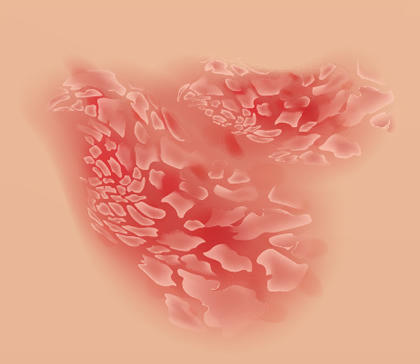 Psoriasis eritrodérmica