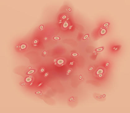 Psoriasis pustulosa