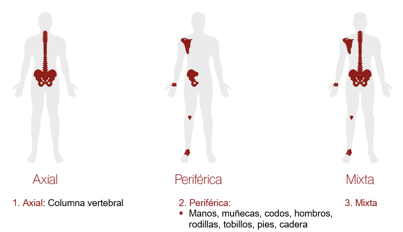 tipos de artritis psoriásica