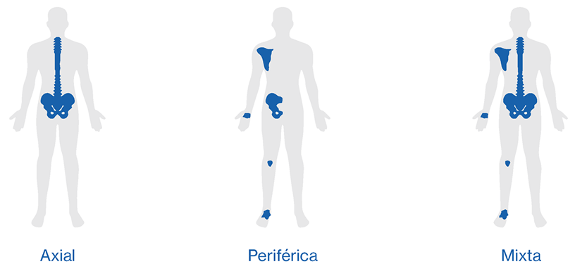 tipos de artritis psoriásica