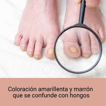 Coloración amarillenta y marrón que se confunde con hongos Coloración amarillenta y marrón que se confunde con hongos