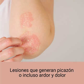 Lesiones que causan picazón o incluso ardor y color. Lesiones que causan picazón o incluso ardor y color.