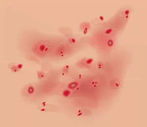 Psoriasis en gotas Psoriasis en gotas
