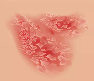 Psoriasis eritrodérmica Psoriasis eritrodérmica