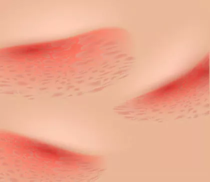 Psoriasis inversa Psoriasis inversa