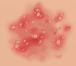 Psoriasis pustulosa Psoriasis pustulosa