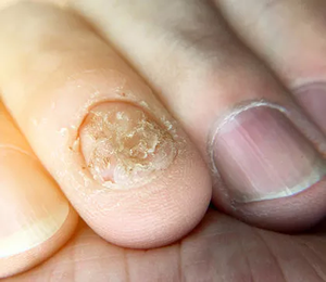 Psoriasis Ungueal Psoriasis Ungueal